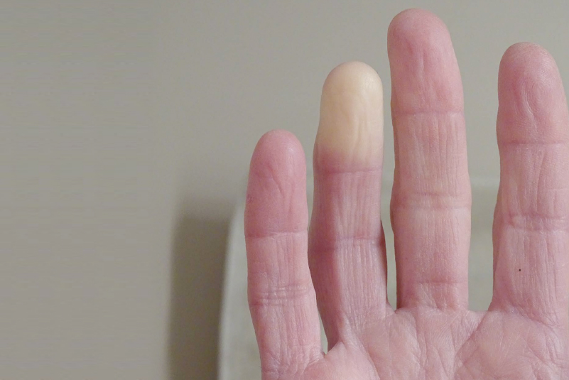 Fenômeno de raynaud