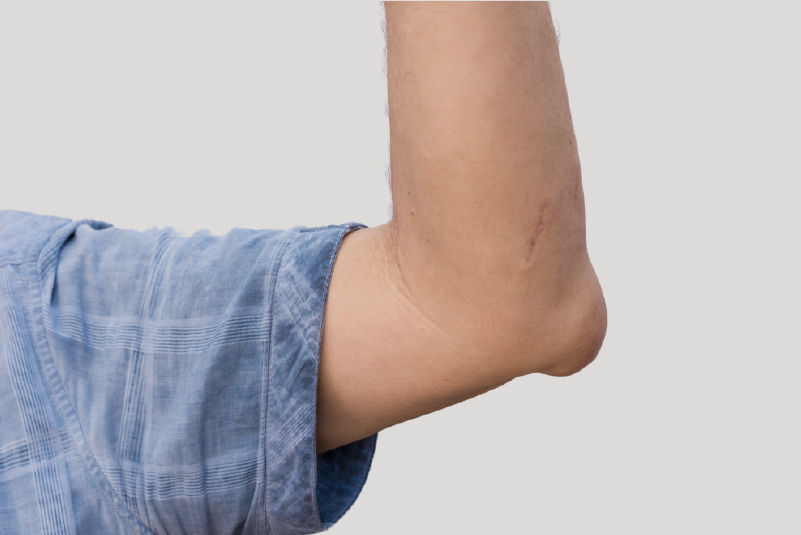 Você já ouviu falar da gota?